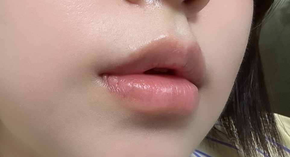 after photo: 입꼬리필러, 입술필러