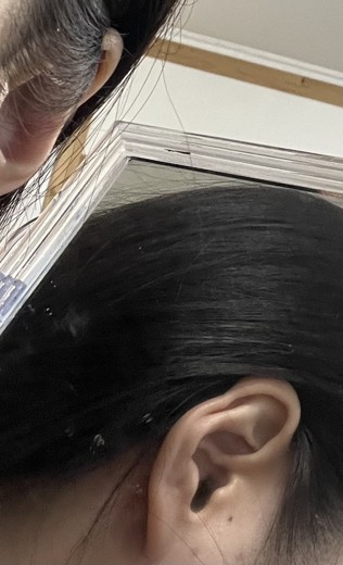 after photo: 캘로이드귀성형