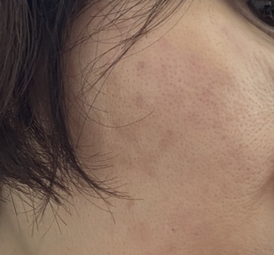 after photo: 리쥬란힐러