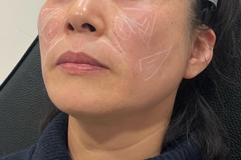 before photo: 쥬베룩