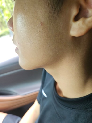 before photo: PDT레이저, 여드름압출