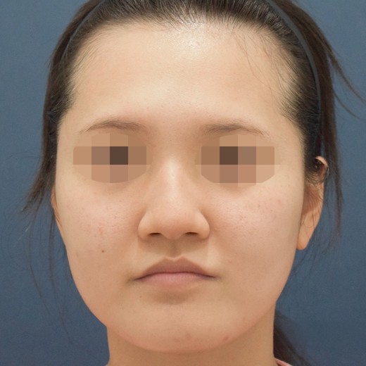 before photo: 콧볼축소