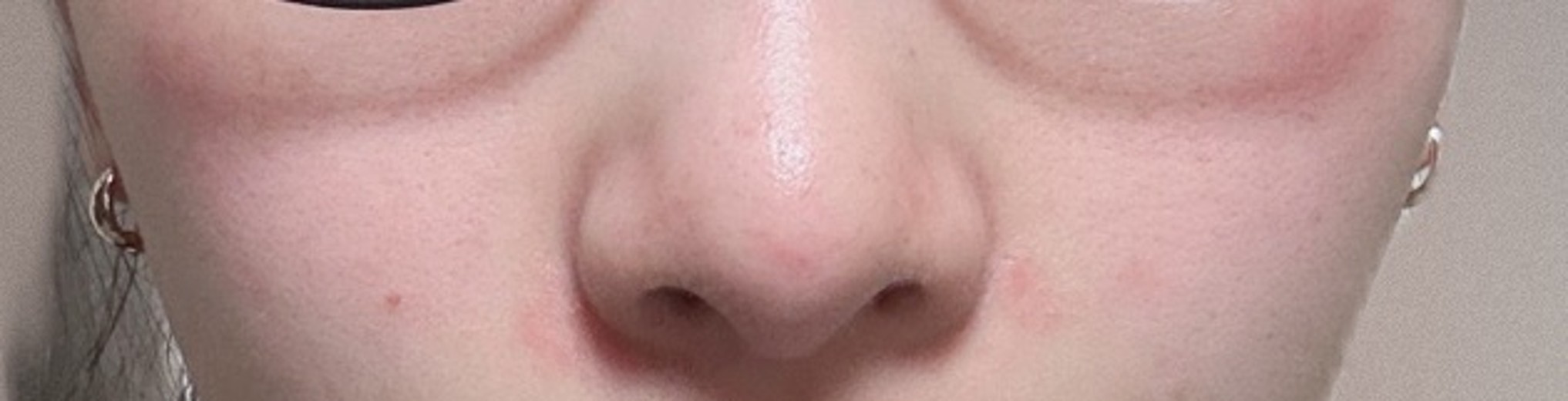 after photo: 脂肪溶解注射(顔)