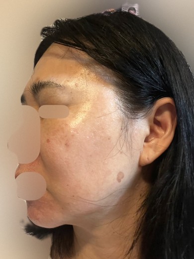after photo: フラクショナルレーザー