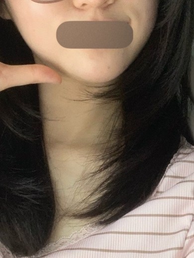 after photo: 필러제거주사