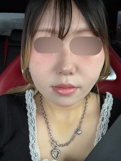 after photo: 糸リフト, 脂肪吸引(顎下), 脂肪吸引(顔), 脂肪吸引(頬)