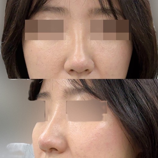 before photo: 콧볼축소