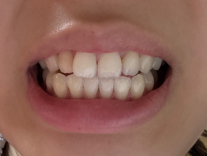 after photo: 치아미백