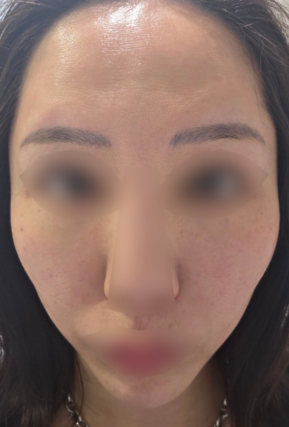 何度でも可】ポテンツァ ダイヤモンドチップ（全顔300ショット）たるみ