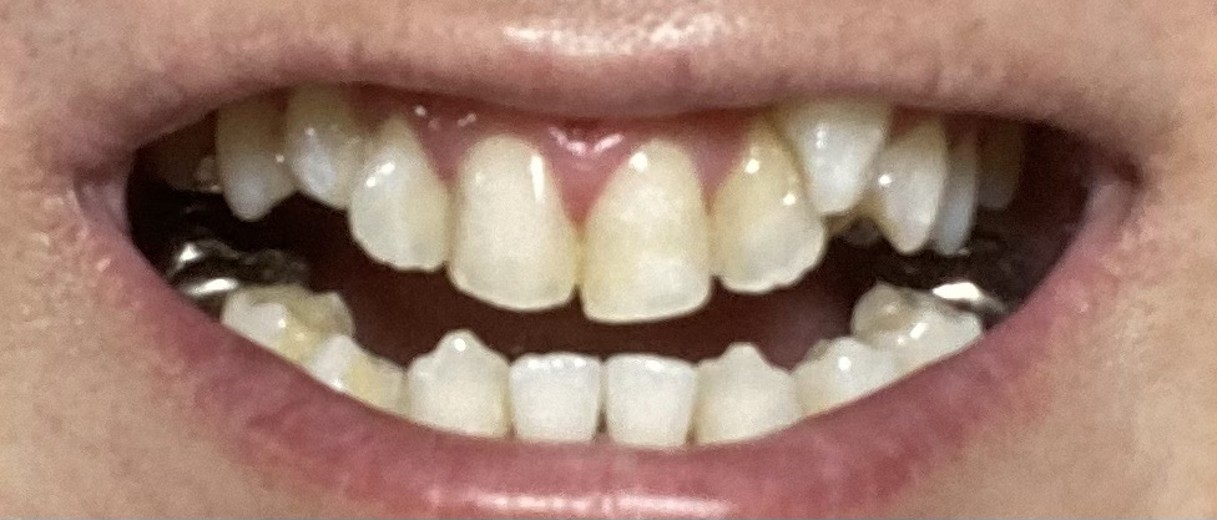 after photo: ホワイトニング