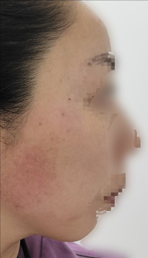 after photo: ルメッカ