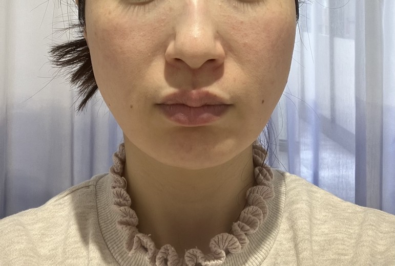 before photo: ジュベルック(Juvelook)