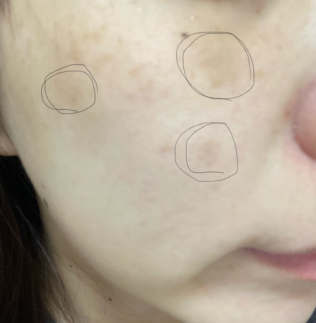 しみ 何度でも可】顔のシミ取り《大きさ制限なし》｜1回 | ZX-CLINIC