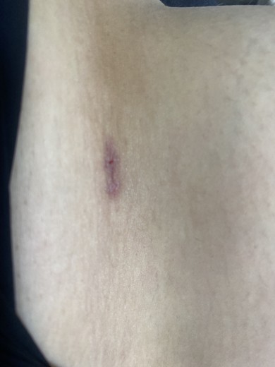 after photo: 豊胸(脂肪注入)