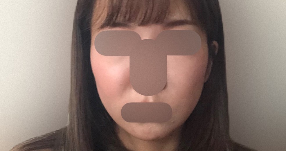 before photo: IPL(光/フォト治療)