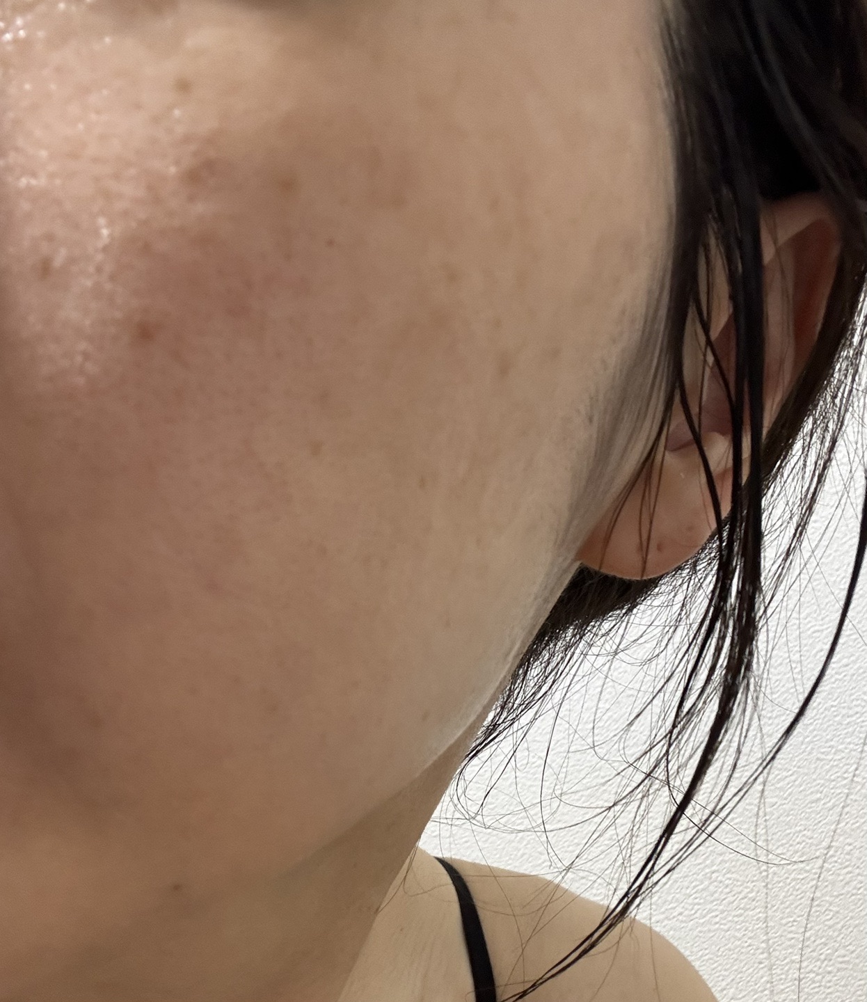 10月15日迄のご予約で初診料0円】全顔シミ取り放題＋美顔