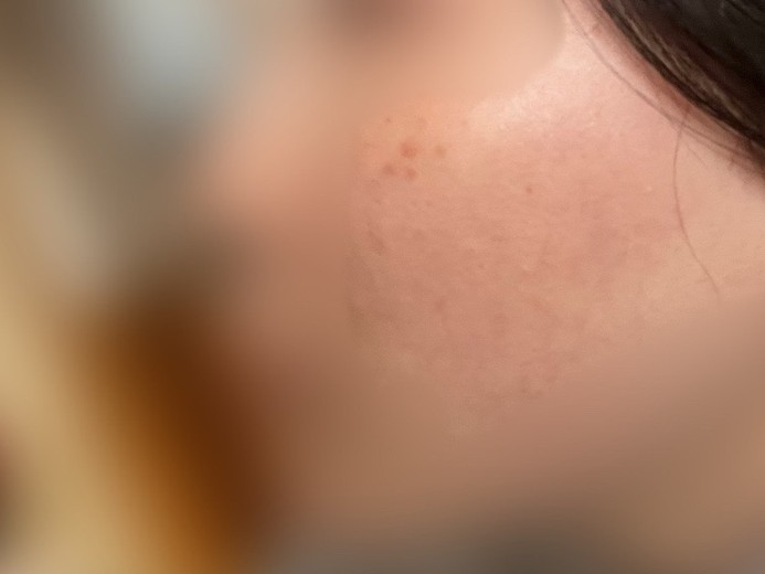 after photo: IPL(光/フォト治療)