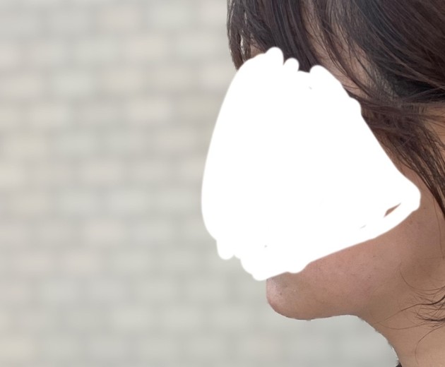 before photo: インモード
