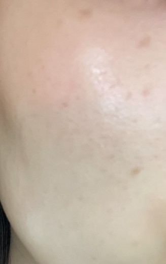 before photo: イオン導入