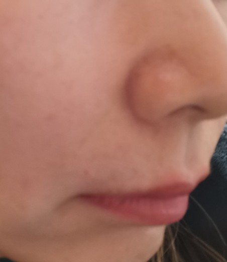 after photo: 脂肪溶解注射(顔)
