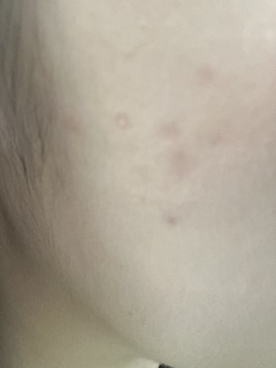 after photo: 피코토닝, 레이저토닝, 제네시스