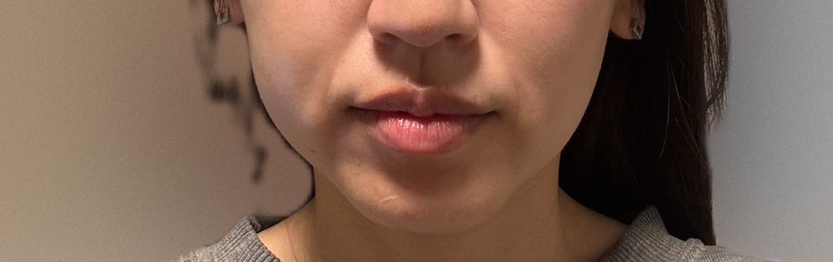 after photo: ハイフ(HIFU)