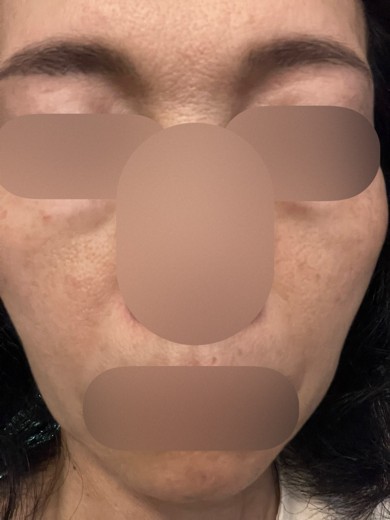 before photo: ミラノリピール