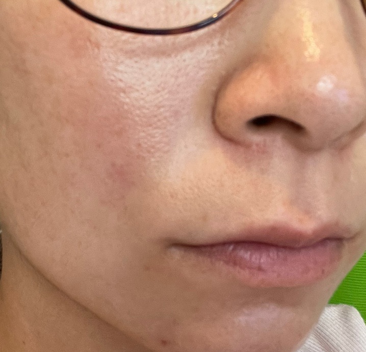 10月15日迄のご予約で初診料0円】IPL（光治療）全顔2周