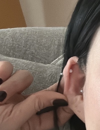 before photo: 귓볼필러