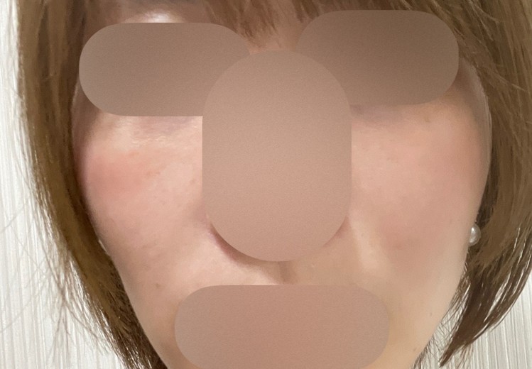 before photo: リズネ(LIZNE)