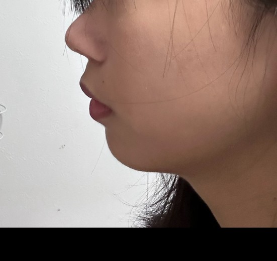 before photo: インモード