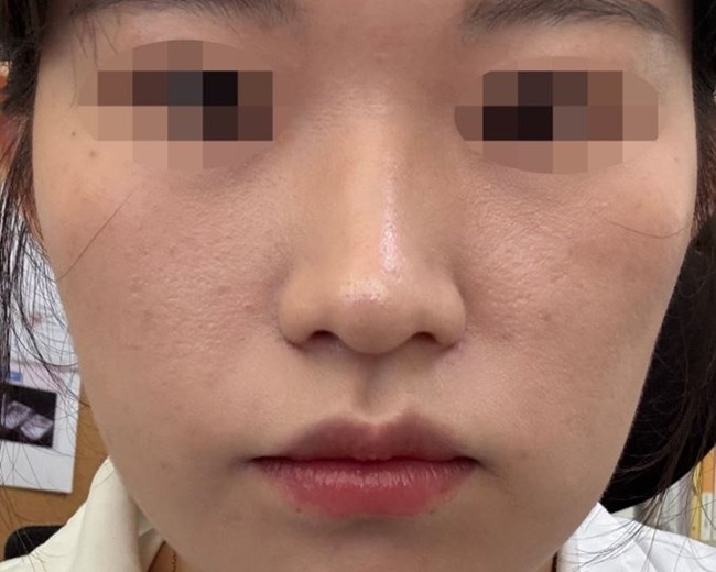 after photo: 콧볼축소