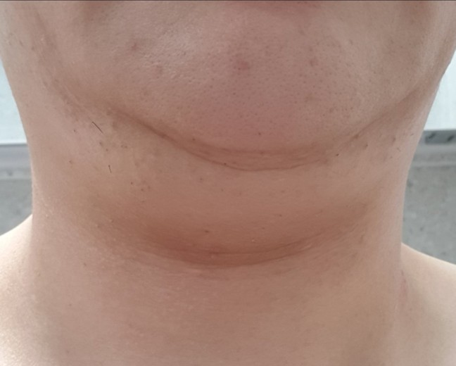 before photo: 이중턱지방흡입, 이중턱근육묶기