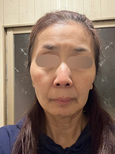 before photo: エレクトロポレーション