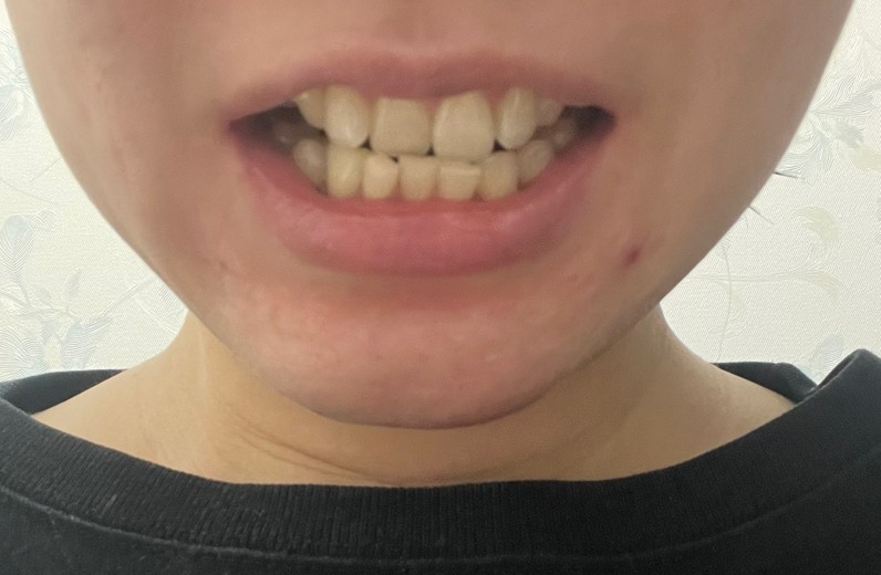 after photo: ホワイトニング