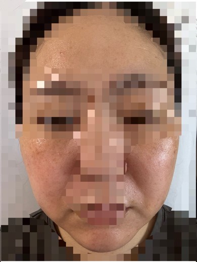 after photo: ピコスポット