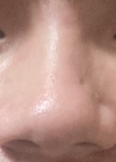 after photo: 脂肪溶解注射(顔)