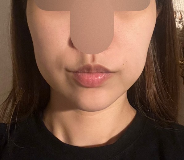before photo: 糸リフト