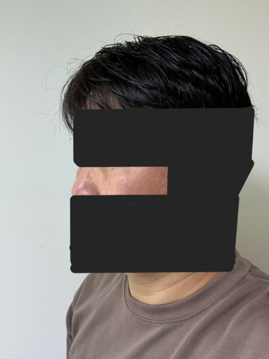 after photo: 눈밑지방재배치