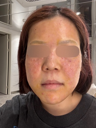 after photo: フラクショナルレーザー, レーザートーニング, ほくろ除去(レーザー)