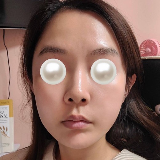 after photo: 울쎄라피프라임