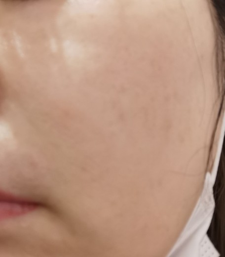 after photo: IPL(光/フォト治療)