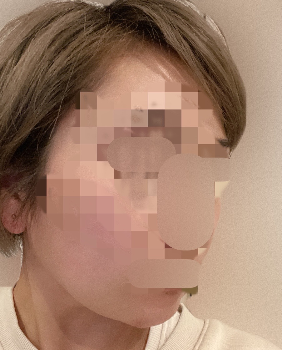 HIFU全顔650shot ウルトラフォーマーMPT【2月28日迄にご予約頂いた方