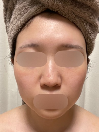 after photo: ダーマペン, エクソソーム