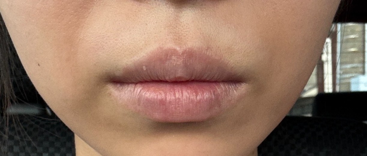 after photo: エラボトックス