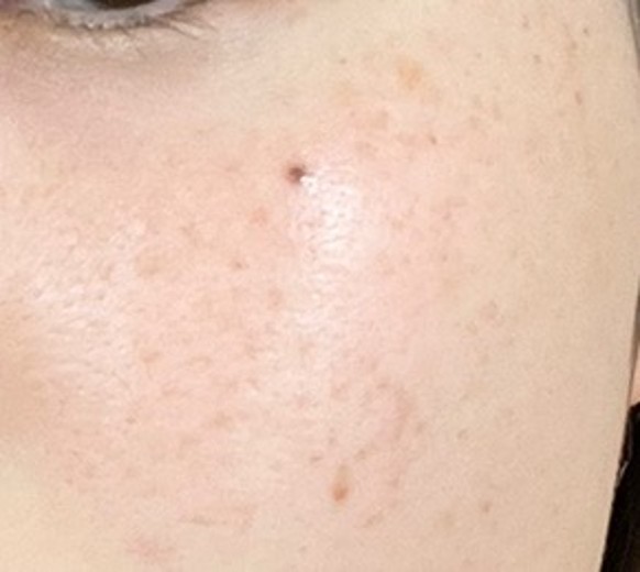 after photo: IPL(光/フォト治療), ピーリング, ルメッカ