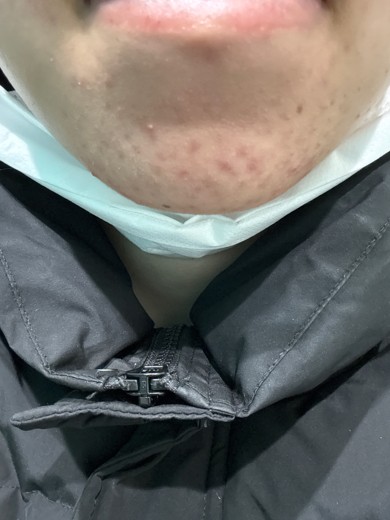 before photo: ダーマペン
