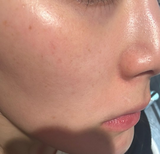 before photo: ダーマペン
