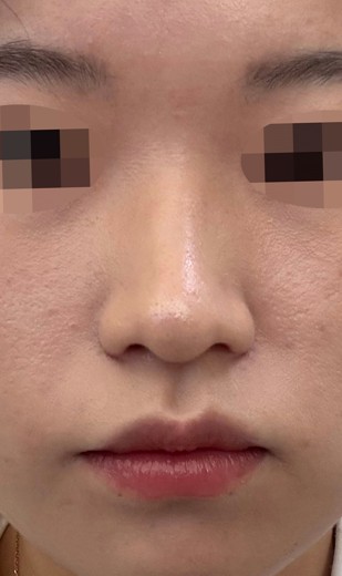 after photo: 콧볼축소