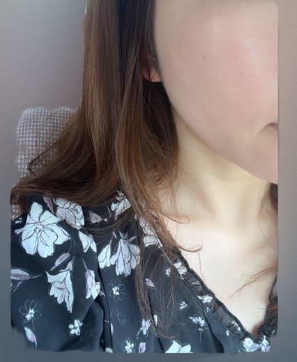 after photo: イオン導入